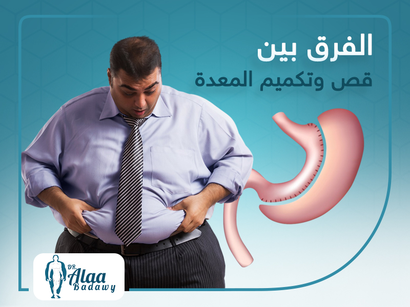 الفرق بين قص المعدة وتكميم المعدة