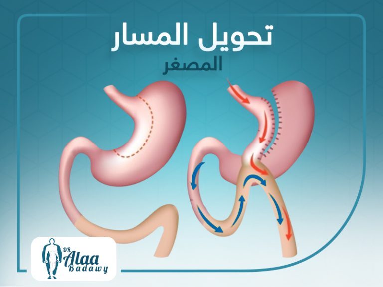 عملية تحويل المسار المصغر