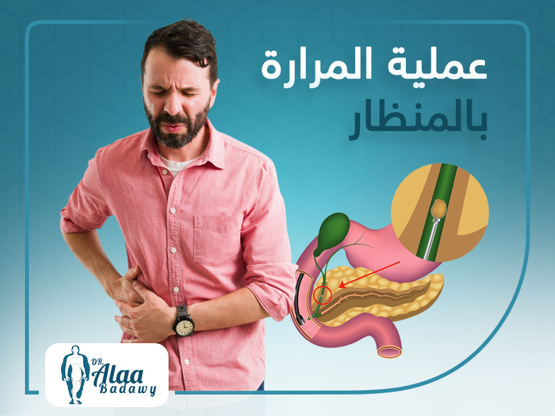 عملية المرارة بالمنظار