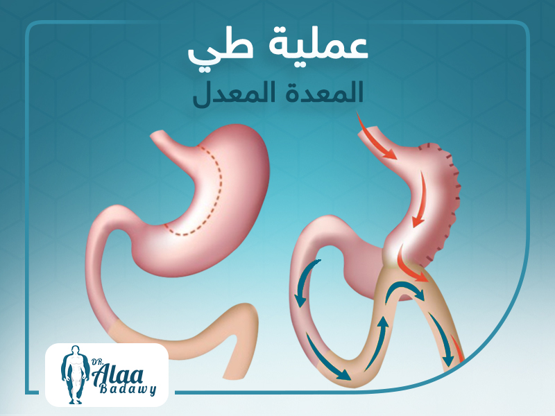 عمليات طي المعدة المعدل