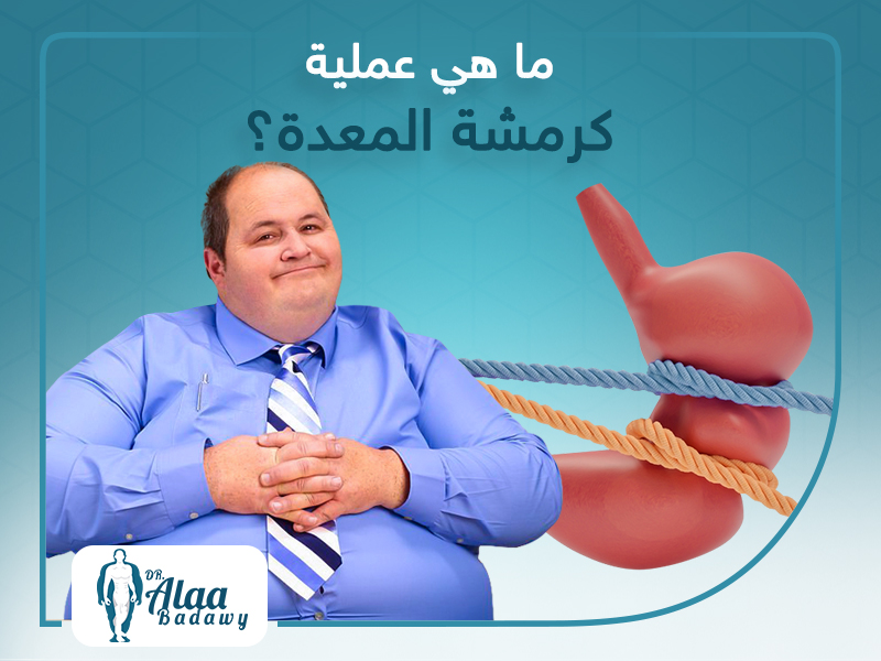 ما هي عملية كرمشة المعدة